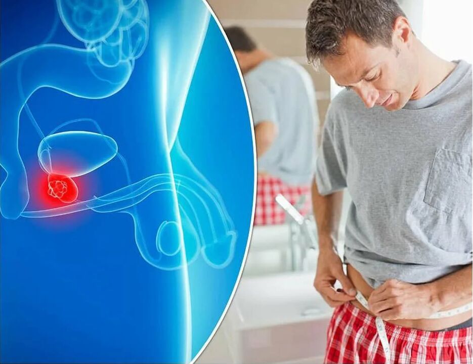 Síntomas e causas da inflamación da próstata
