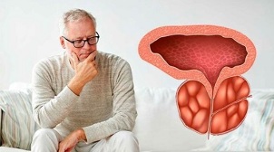 Causas da prostatite bacteriana nos homes