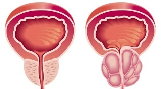 Razóns para o desenvolvemento de prostatite e adenoma de próstata