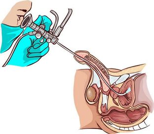 Procedemento de ureteroscopia